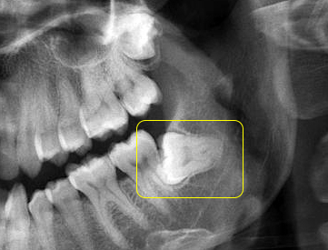 עקירות שיני בינה כירורגית